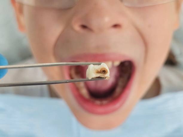 Best Emergency Tooth Extraction in Barnum Island, NY